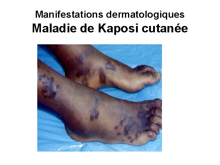 Manifestations dermatologiques Maladie de Kaposi cutanée 