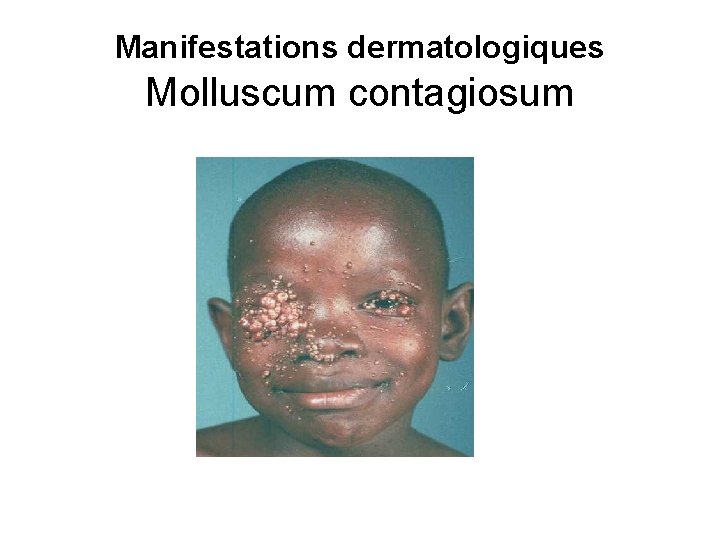 Manifestations dermatologiques Molluscum contagiosum 