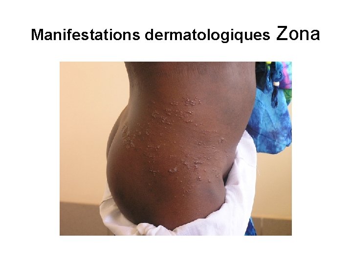 Manifestations dermatologiques Zona 