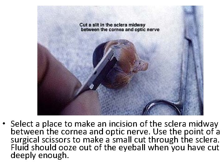  • Select a place to make an incision of the sclera midway between