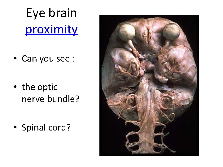 Eye brain proximity • Can you see : • the optic nerve bundle? •