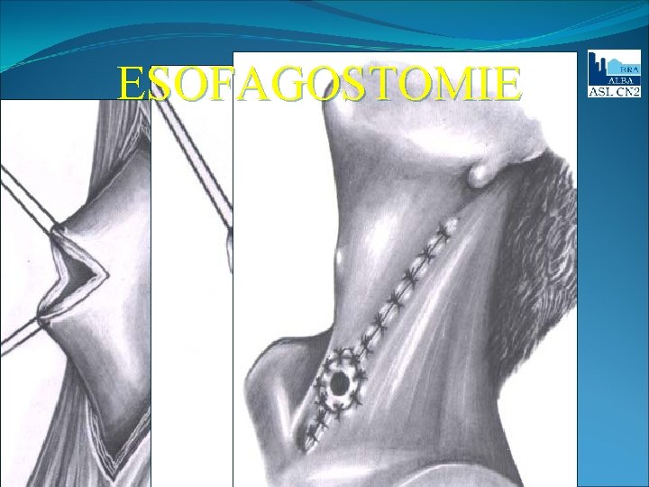 ESOFAGOSTOMIE NELLE PERFORAZIONI O FISTOLE DELL’ESOFAGO TORACICO (per deviare all’esterno la saliva) 