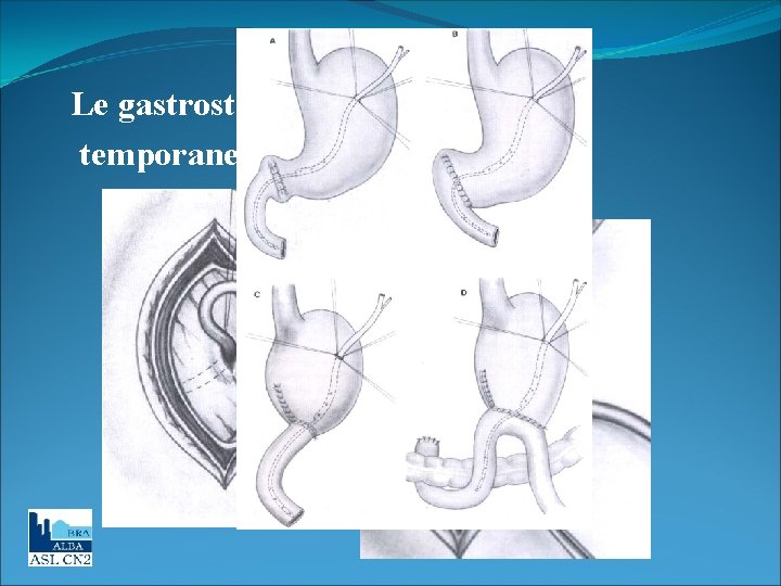 Le gastrostomie di minima, temporanee ieri…. 
