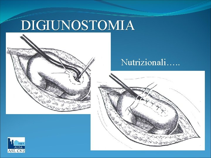 DIGIUNOSTOMIA Nutrizionali…. . 