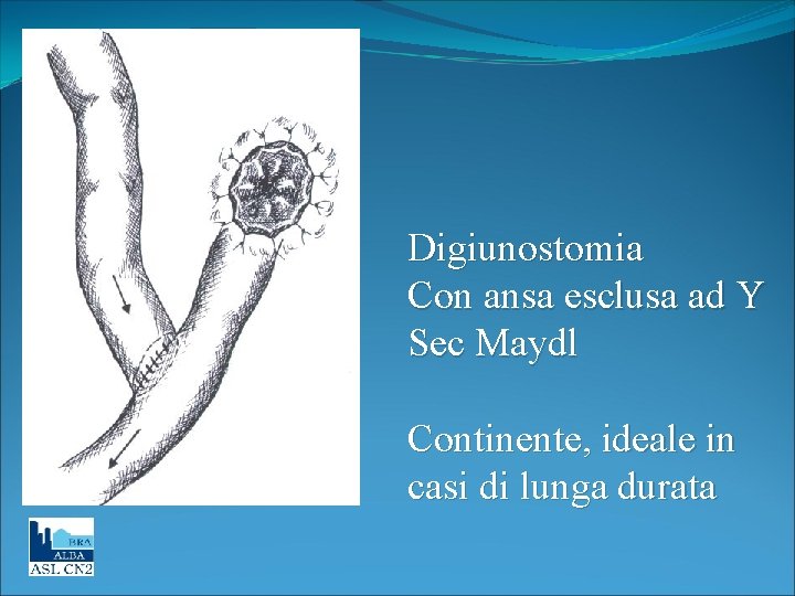 Digiunostomia Con ansa esclusa ad Y Sec Maydl Continente, ideale in casi di lunga