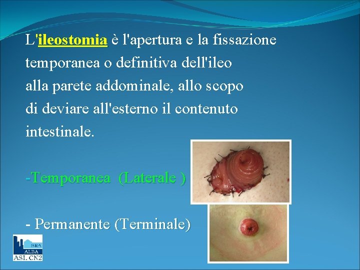 L'ileostomia è l'apertura e la fissazione temporanea o definitiva dell'ileo alla parete addominale, allo