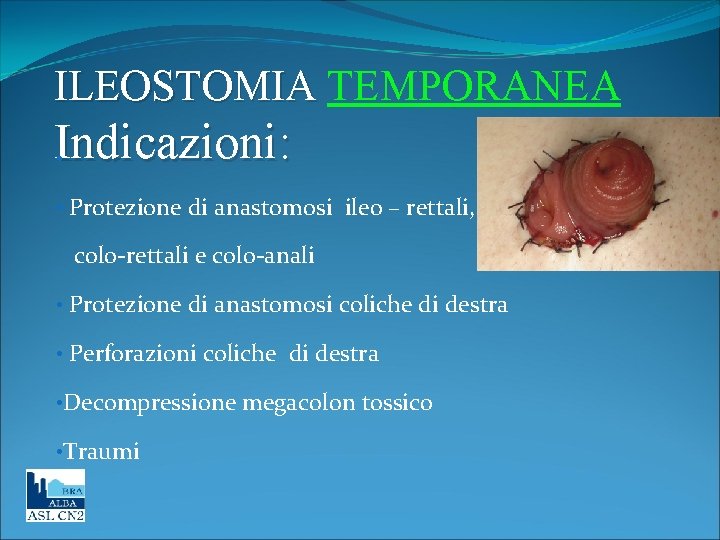 ILEOSTOMIA TEMPORANEA Indicazioni: • • Protezione di anastomosi ileo – rettali, colo-rettali e colo-anali