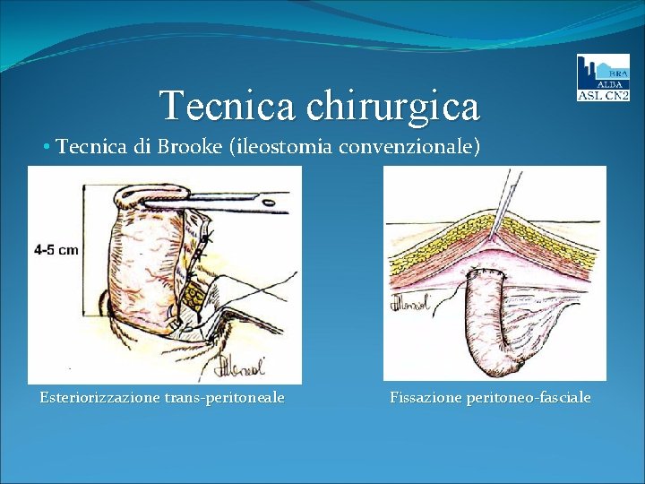 Tecnica chirurgica • Tecnica di Brooke (ileostomia convenzionale) Esteriorizzazione trans-peritoneale Fissazione peritoneo-fasciale 