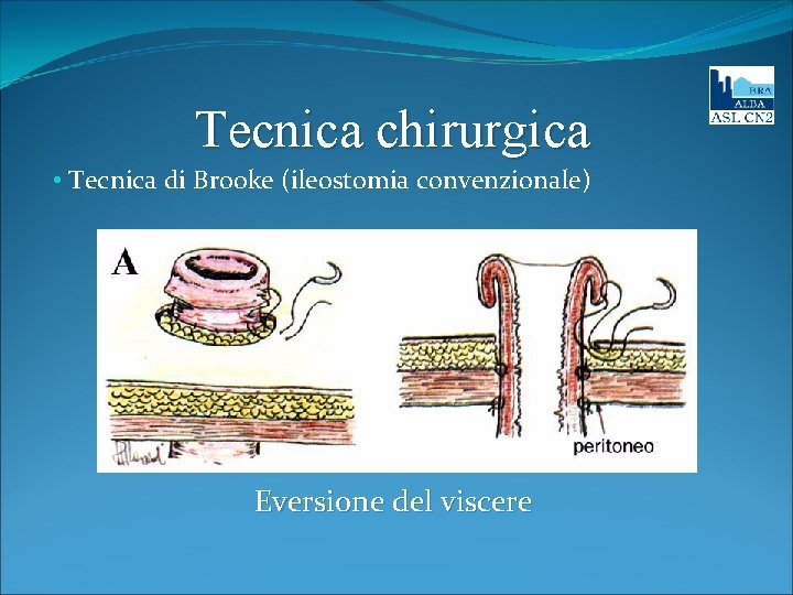 Tecnica chirurgica • Tecnica di Brooke (ileostomia convenzionale) Eversione del viscere 