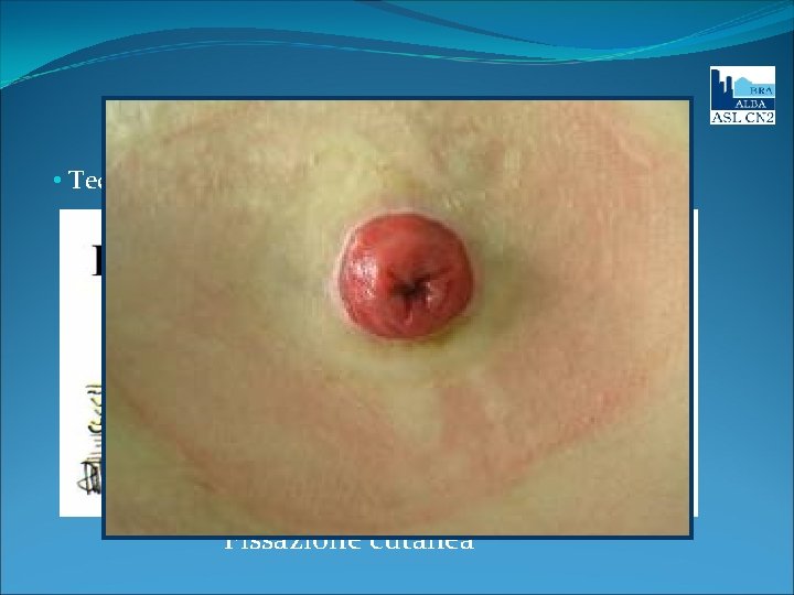 Tecnica chirurgica • Tecnica di Brooke (ileostomia convenzionale) Fissazione cutanea 