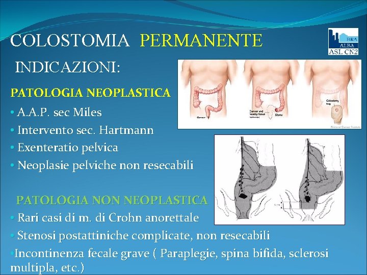COLOSTOMIA PERMANENTE INDICAZIONI: PATOLOGIA NEOPLASTICA • A. A. P. sec Miles • Intervento sec.
