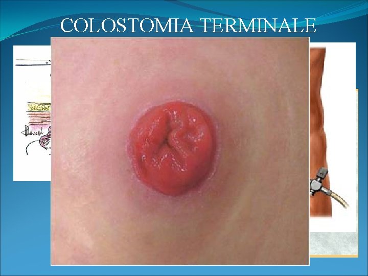 COLOSTOMIA TERMINALE 