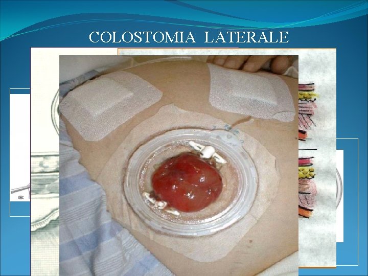 COLOSTOMIA LATERALE Tecnica chirurgica: 1. ’sperone’ 2. sutura peritoneo 3. sutura cute 