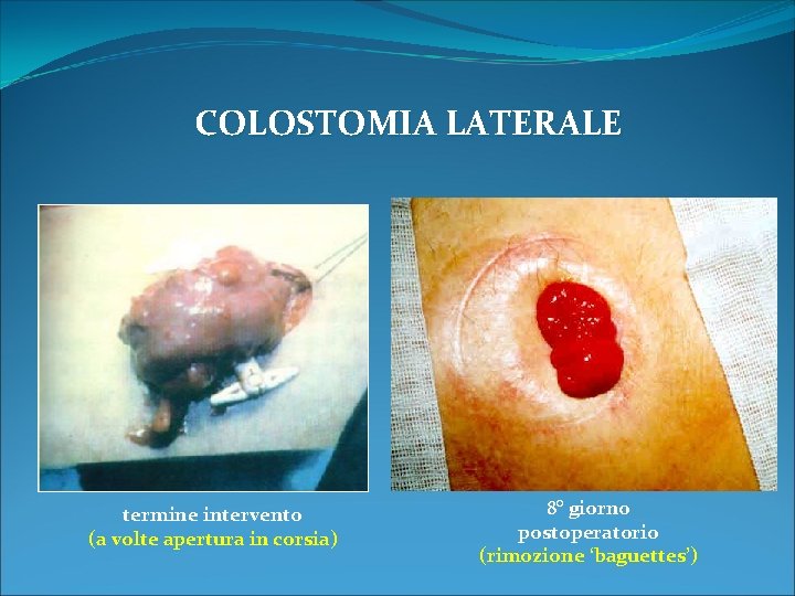 COLOSTOMIA LATERALE termine intervento (a volte apertura in corsia) 8° giorno postoperatorio (rimozione ‘baguettes’)