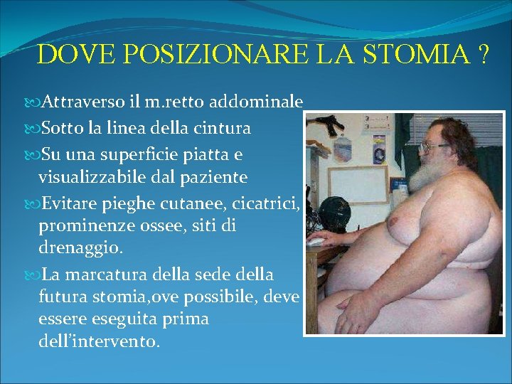 DOVE POSIZIONARE LA STOMIA ? Attraverso il m. retto addominale Sotto la linea della