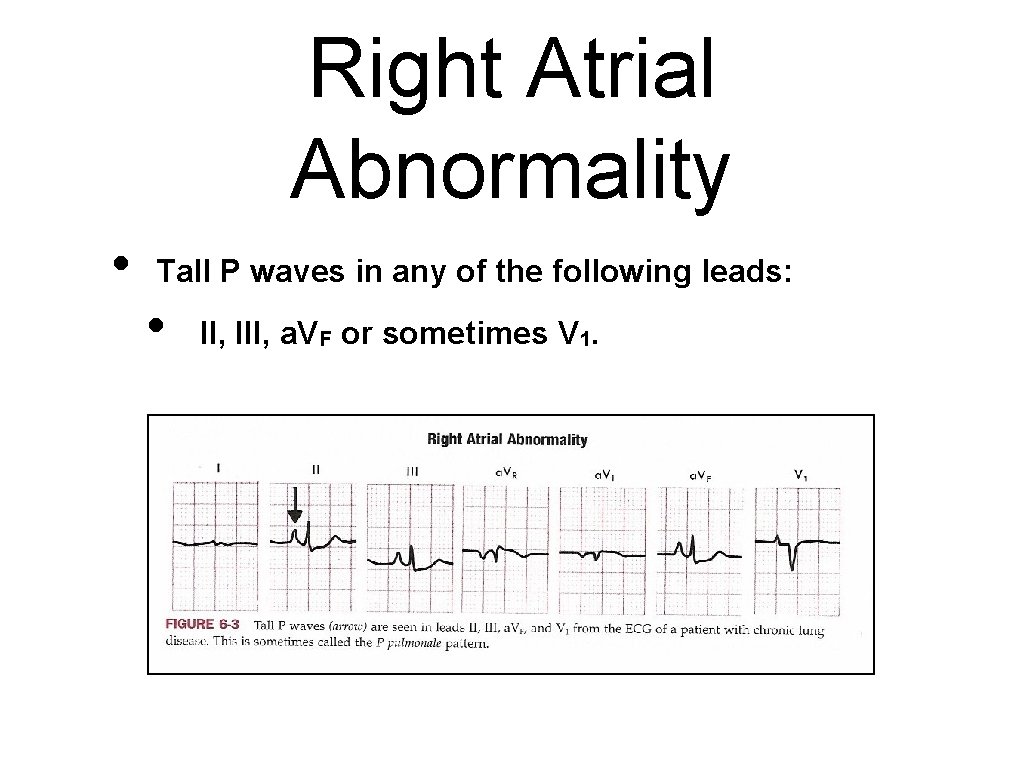 Right Atrial Abnormality • Tall P waves in any of the following leads: •