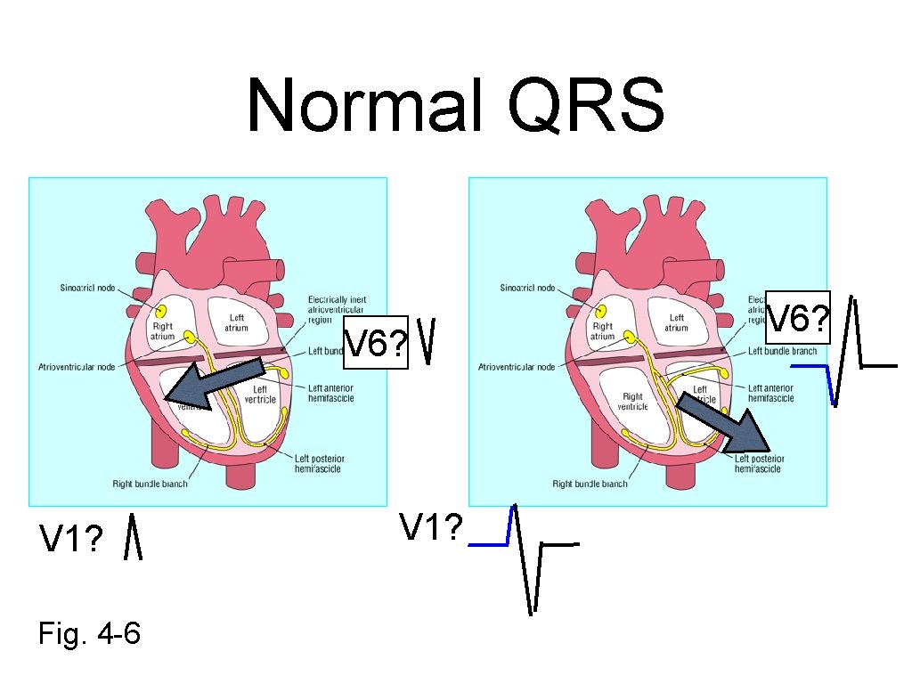 Normal QRS V 6? V 1? Fig. 4 -6 V 1? V 6? 