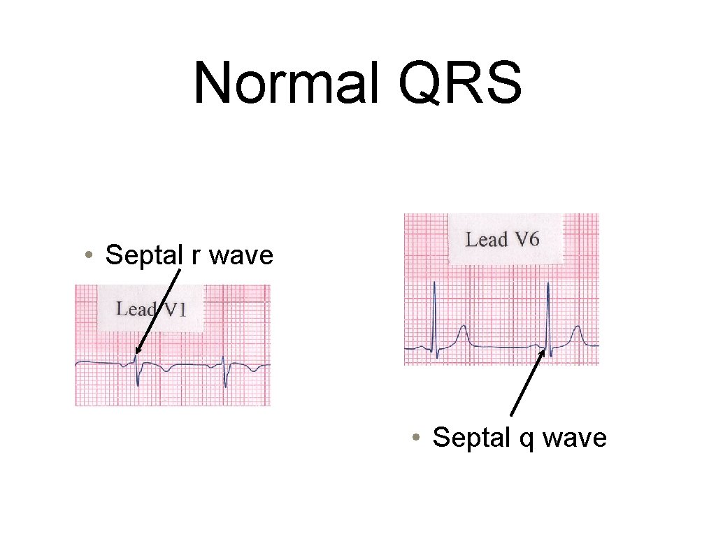 Normal QRS • Septal r wave • Septal q wave 