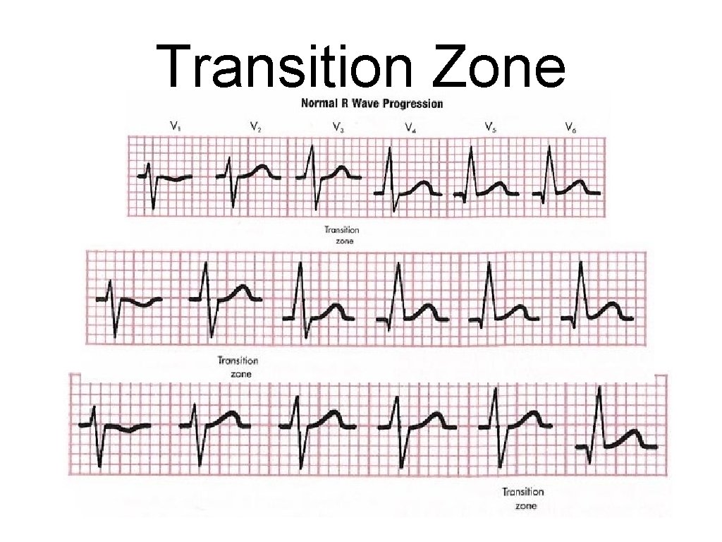 Transition Zone 