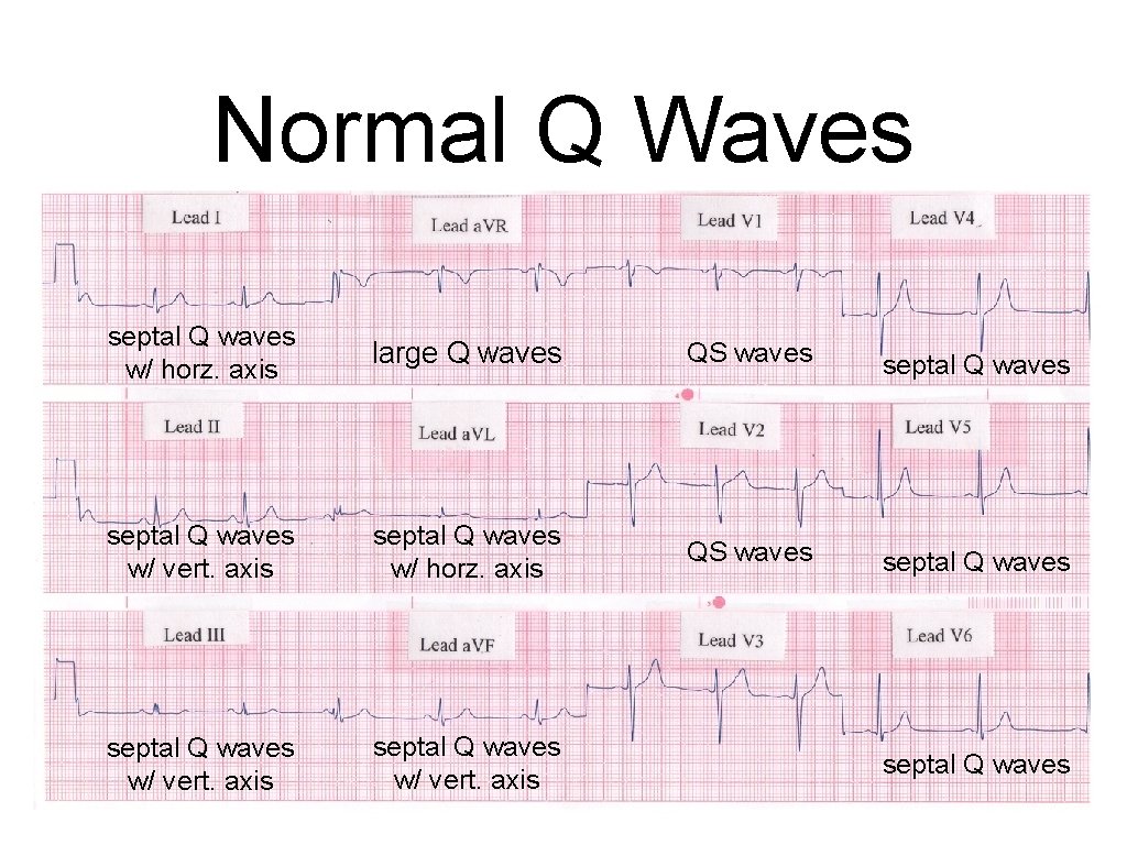 How To Interpret An ECG Chapter 22 ECG
