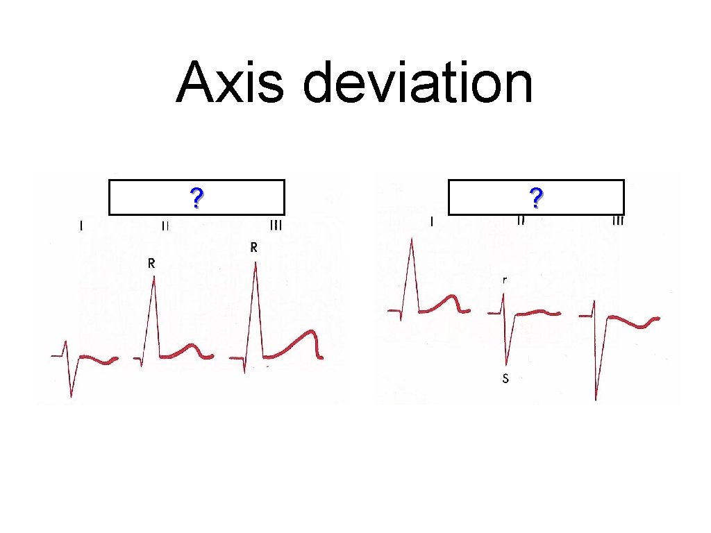 Axis deviation ? ? 