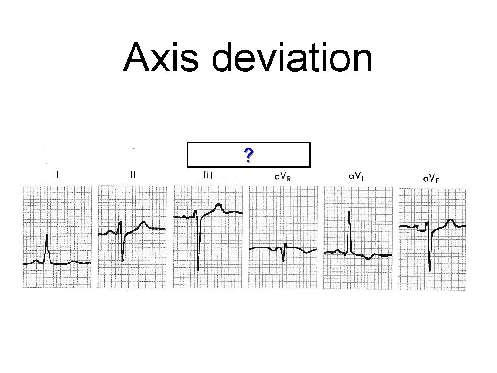 Axis deviation ? 