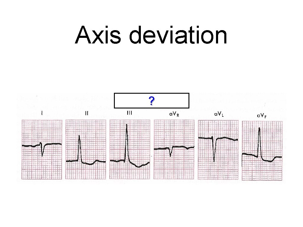 Axis deviation ? 