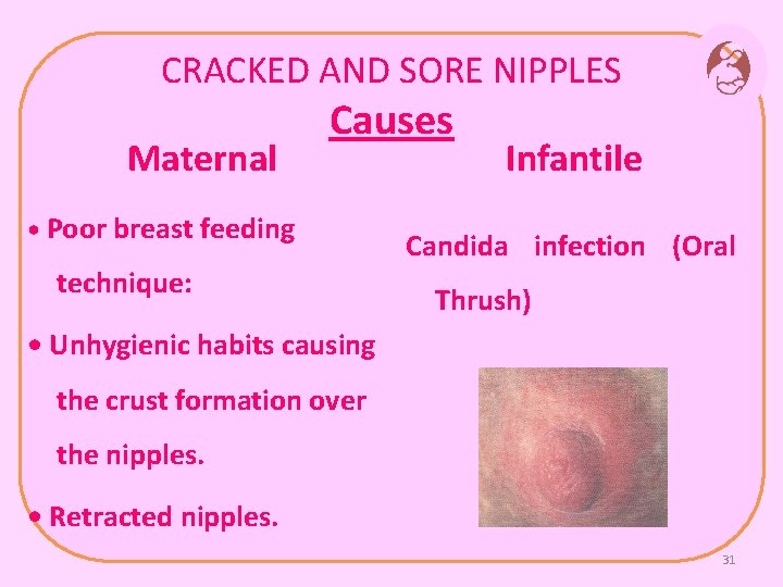 CRACKED AND SORE NIPPLES Maternal Causes • Poor breast feeding technique: Infantile Candida infection