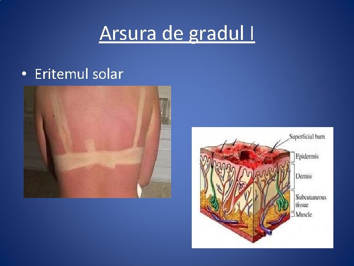 Arsura de gradul I • Eritemul solar 