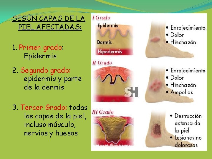 SEGÚN CAPAS DE LA PIEL AFECTADAS: 1. Primer grado: Epidermis 2. Segundo grado: epidermis