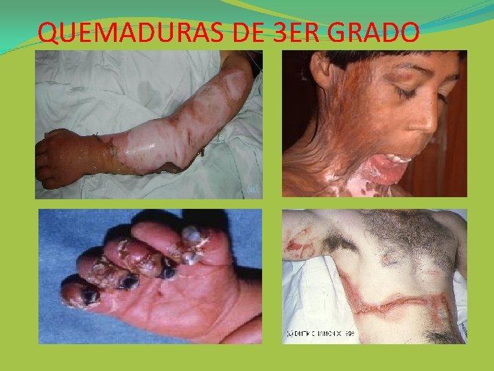 QUEMADURAS DE 3 ER GRADO 