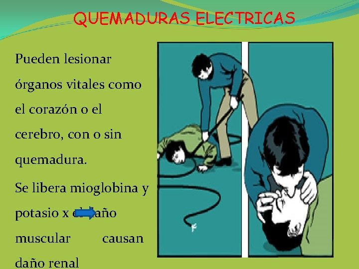 QUEMADURAS ELECTRICAS Pueden lesionar órganos vitales como el corazón o el cerebro, con o