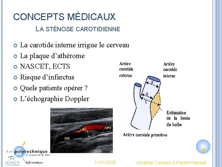 CONCEPTS MÉDICAUX LA STÉNOSE CAROTIDIENNE La carotide interne irrigue le cerveau La plaque d’athérome