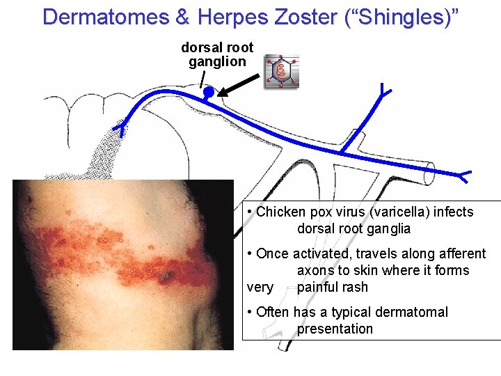 Dermatomes & Herpes Zoster (“Shingles)” dorsal root ganglion • Chicken pox virus (varicella) infects Dermatomes & Herpes Zoster (“Shingles)” dorsal root ganglion • Chicken pox virus (varicella) infects