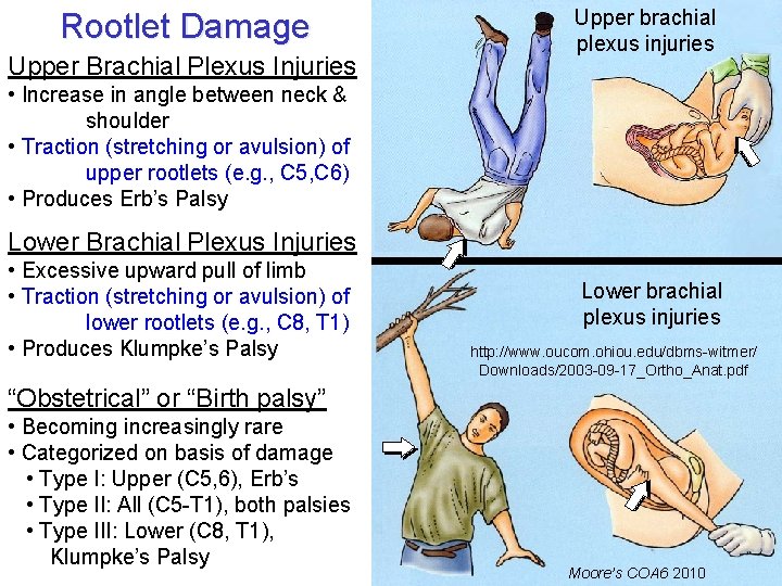 Rootlet Damage Upper Brachial Plexus Injuries Upper brachial plexus injuries • Increase in angle Rootlet Damage Upper Brachial Plexus Injuries Upper brachial plexus injuries • Increase in angle