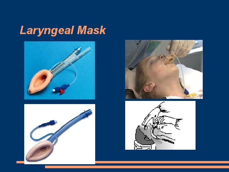 Laryngeal Mask 
