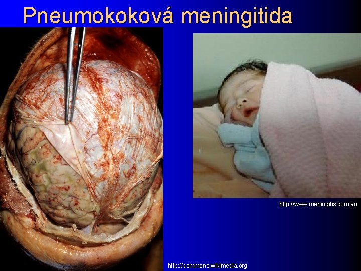Pneumokoková meningitida http: //www. meningitis. com. au http: //commons. wikimedia. org 