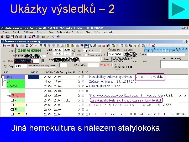 Ukázky výsledků – 2 Jiná hemokultura s nálezem stafylokoka 