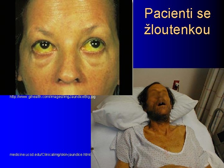 Pacienti se žloutenkou http: //www. gihealth. com/images/img. Jaundice. Big. jpg medicine. ucsd. edu/Clinicalimg/skin-jaundice. html.