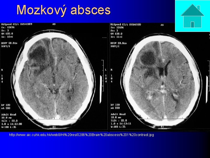 Mozkový absces http: //www. aic. cuhk. edu. hk/web 8/Hi%20 res/0286%20 Brain%20 abscess%201%20 contrast. jpg