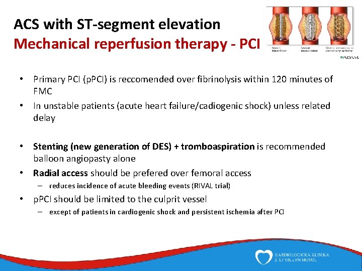 ACS with ST-segment elevation Mechanical reperfusion therapy - PCI • Primary PCI (p. PCI)