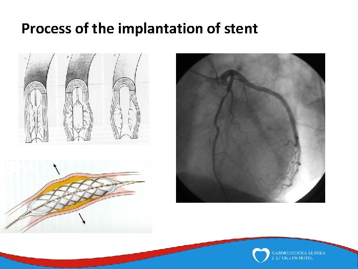 Process of the implantation of stent 