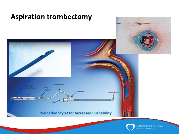 Aspiration trombectomy 