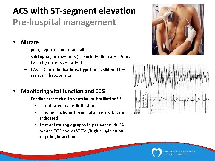 ACS with ST-segment elevation Pre-hospital management • Nitrate – pain, hypertesion, heart failure –