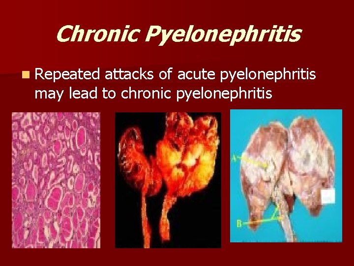 Chronic Pyelonephritis n Repeated attacks of acute pyelonephritis may lead to chronic pyelonephritis 