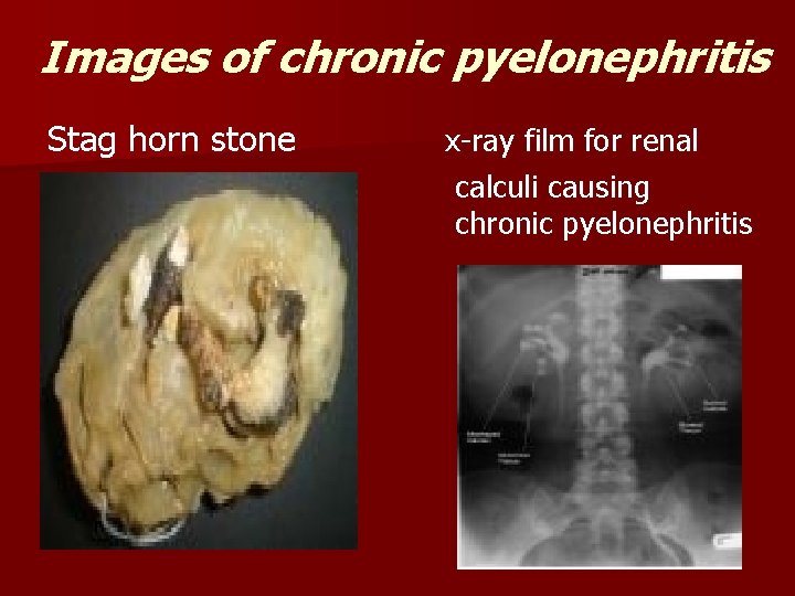 Images of chronic pyelonephritis Stag horn stone x-ray film for renal calculi causing chronic