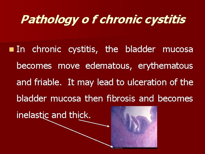 Pathology o f chronic cystitis n In chronic cystitis, the bladder mucosa becomes move Pathology o f chronic cystitis n In chronic cystitis, the bladder mucosa becomes move