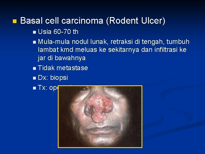 n Basal cell carcinoma (Rodent Ulcer) n Usia 60 -70 th n Mula-mula nodul