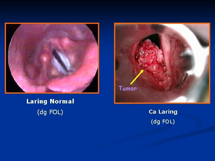 Tumor Laring Normal (dg FOL) Ca Laring (dg FOL) 
