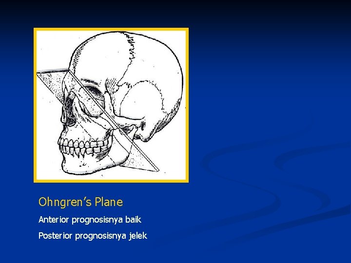 Ohngren’s Plane Anterior prognosisnya baik Posterior prognosisnya jelek 